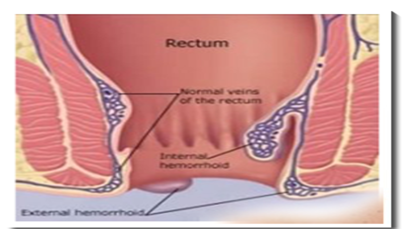 Common Types of Rectal Dysfunction
