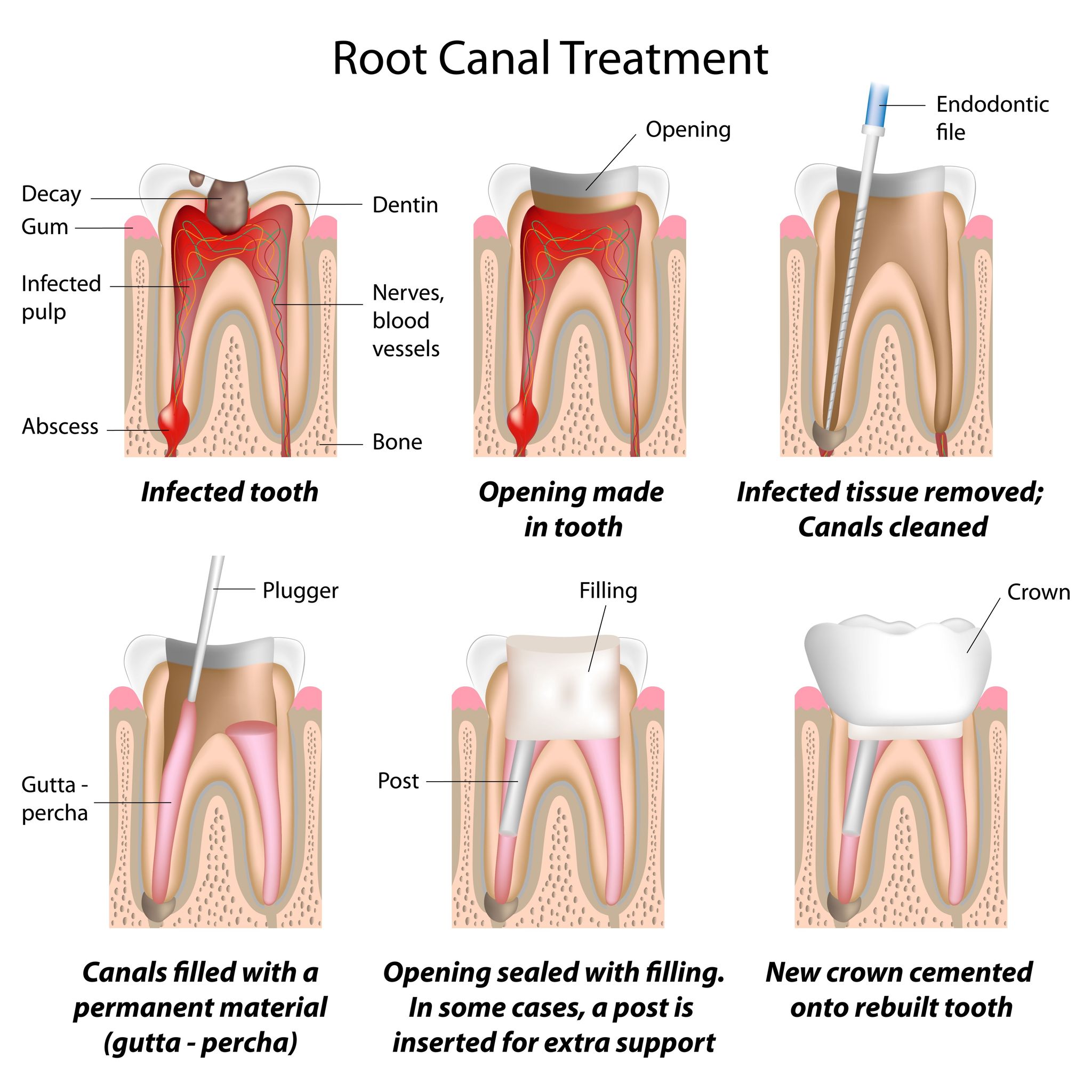 Dentistry Professionals Recommend a Root Canal Treatment to Preserve a Badly Decayed Tooth