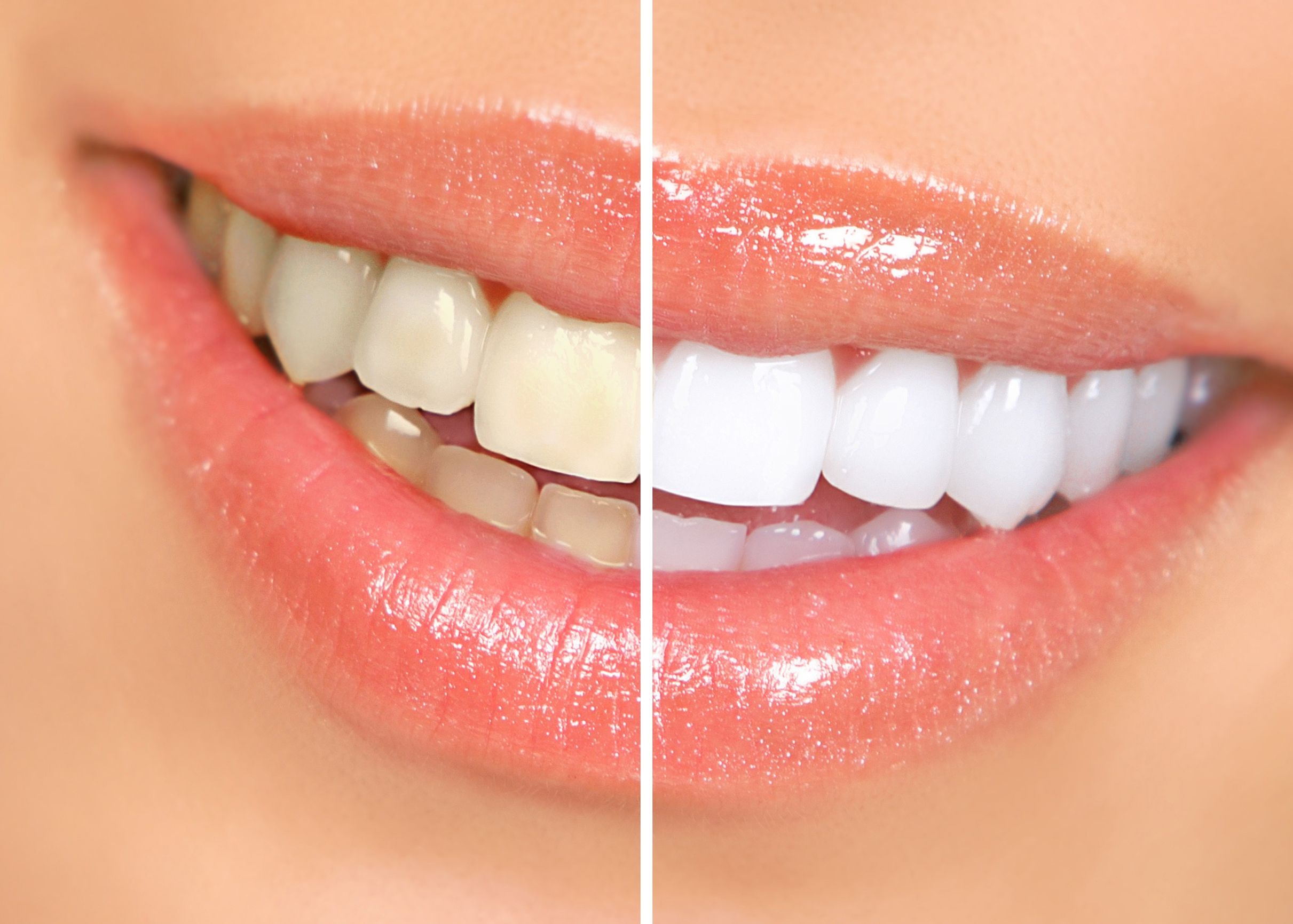 What Exactly Can A Patient Expect from Teeth Whitening in Bridgeport ,CT?