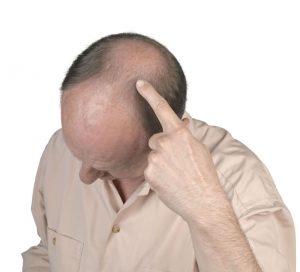 Common Reasons Why Men Consider Hair Transplants in Mclean, VA