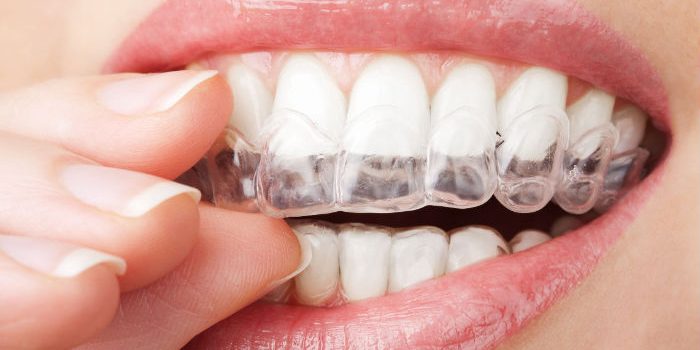 Signs You Need Orthodontics in Chanhassen, MN