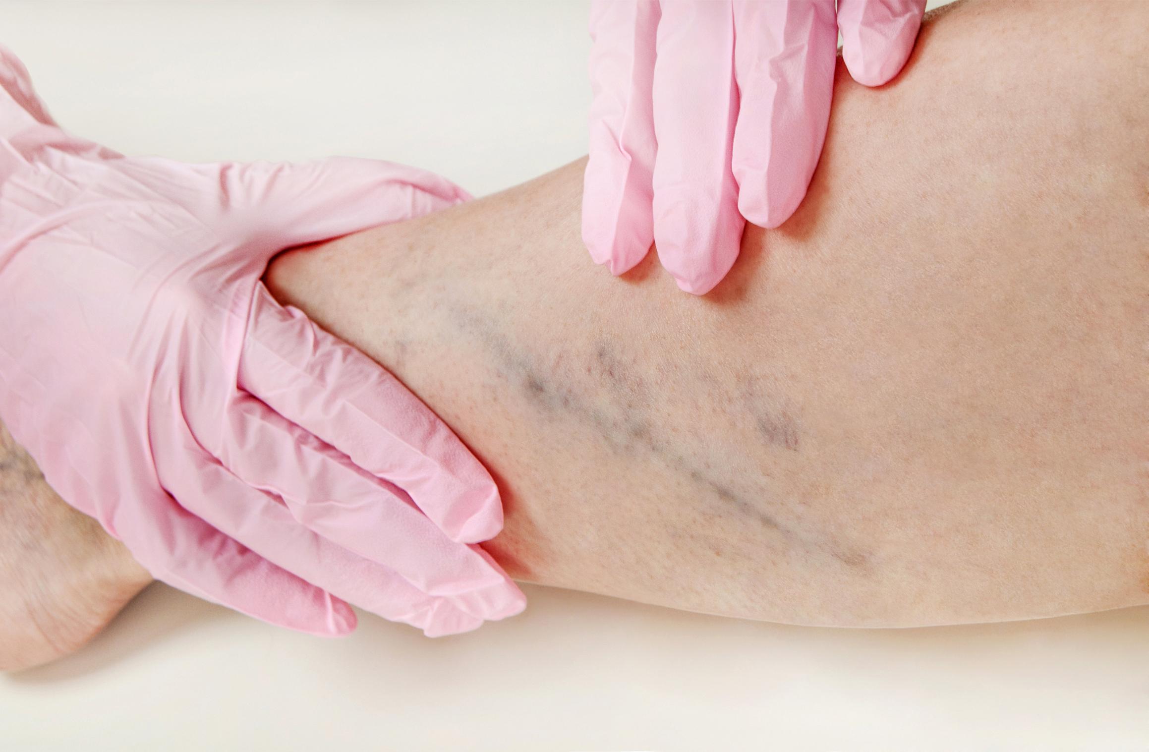 4 Dangers of Neglecting Varicose Vein Treatment in New Jersey