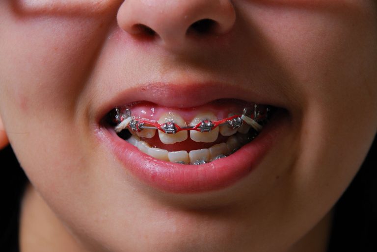 Treatments Provided By An Orthodontist In Medina OH