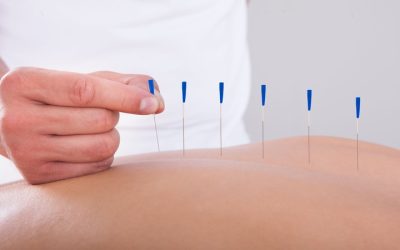 Achieve balance and pain relief with acupuncture therapy in Costa Mesa, CA