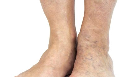 Varicose and Spider Vein Treatment Options
