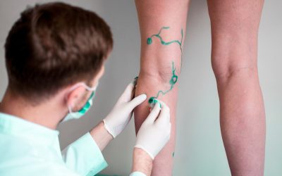 Vein Issues And Vein Treatment In New York