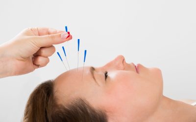 Discover Holistic Healing at Acupuncture Clinic Burbank CA for Stress Relief