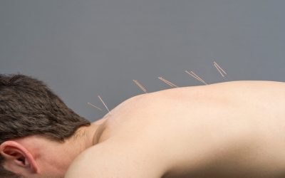 Relieve Daily Tension with Acupuncture Therapy For Stress in Sudden Valley, WA Residents Trust