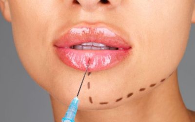 Steps to Achieve Symmetry With Lip Fillers and Enhancement Bloomington MN